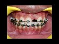 impacted tooth ortho surgical management orthodontics