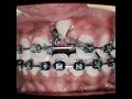 impacted tooth ortho surgical management orthodontics