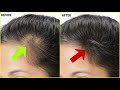 முடி உதிர்வுக்கு முடிவு கட்ட இந்த மூன்று பொருட்களே போதும் home remedies to treat hair fall