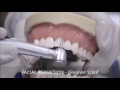 tooth preparation for an all ceramic crown