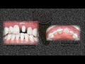 tooth preparation for an all ceramic crown