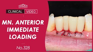 Lower Anterior Immediate Implant Placement with Restoration [Dr. Kim Jaeyoon]