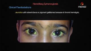 Hereditary Spherocytosis - Usmle case based Highyield lecture