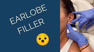 Earlobe Filler | Make Old Ears Look New Again