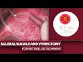 Scleral Buckle and vitrectomy for retinal detachment