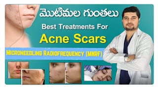 మొటిమల గుంతలు ||  Best Treatments For Acne Scars in Telugu || MNRF Treatment || Dr Netis Skin Clinic