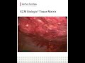 XCM Biologic® Tissue Matrix Laparoscopic Post-op Video