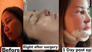 PART 1: How is my Surgery turned out ( Rhinoplasty, Chin Augmentation, Liposuction )