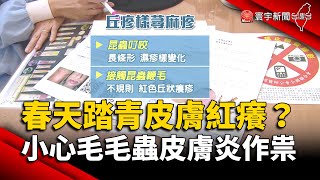 春天踏青皮膚紅癢？小心毛毛蟲皮膚炎作祟｜#寰宇新聞 @globalnewstw