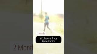 Back to Running after ACL Reconstruction with Fibertape Intrenal brace