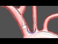 Animation of Sentinel™ Cerebral Protection System