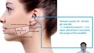 Advanced Botox Injection Techniques for Dentists | Part 3: Masseter Hypertrophy