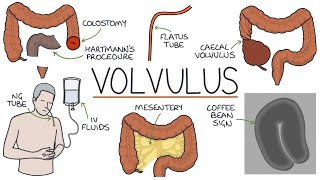 Volvulus (Twisted Bowel) | Drk