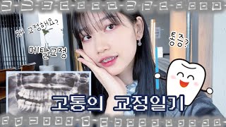 [vlog] 고통의 교정일기… 메탈교정 후기🦷✨ 왜 했냐구요? (치아교정| 교정 브이로그| 통증| 식사)