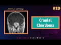 Cranial Chordoma | Radiology Tutorials | 1000 cases in100 days | Radiology Everywhere | video 19