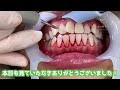 【閲覧注意】歯石が溜まって歯の形がわからない😱‼️歯石除去して綺麗に✨ tartar removal