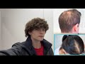 First signs of androgenic alopecia, how to tell and to start treatment