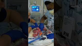 Conjoined twins born at UC Davis Children’s Hospital