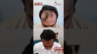 Long Hair Transplant Surgery After 3rd day Result | Hair Transplant Before After #shorts