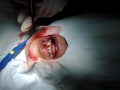 雷射手術 下嘴唇 癌前病變 laser excision of precancer lesion of lower lip dr. ken liao liu