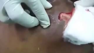 *** Butt abscess Removal Explosion ***