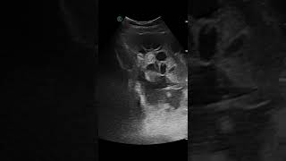 32F，OHSS with ascites. POCUS assisted paracentesis 1100ml. #ApacheUltrasoud