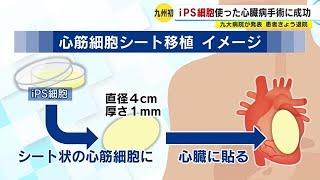 九州初　ｉＰＳ細胞使った心臓病手術に成功　九大病院が発表　患者は１４日に退院  (23/02/14 16:50)