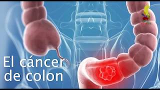 Spot  cáncer de colon prevención