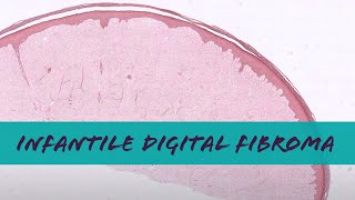 Infantile digital fibroma (inclusion body fibromatosis) pathology dermatology dermpath