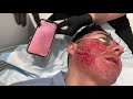 IMPROVE CHEEK ACNE SCARS WITH DEEP HALO AND PROFRACTIONAL LASER |West Hollywood, CA | Dr. Jason Emer