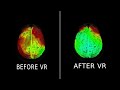 eeg before and after healium