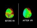 eeg before and after healium