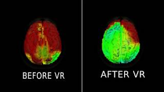 EEG Before and After Healium