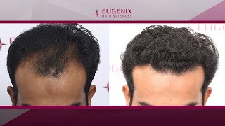 FUE/DHT Hair Transplant update post 10 Months | Grafts 2357, Norwood Grade 3A @Eugenix Hair Sciences