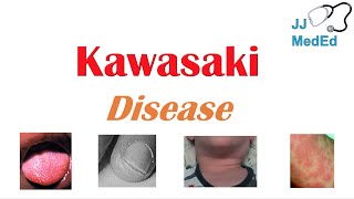 Kawasaki Disease | What is it, symptoms, treatment and complications (ex. heart failure)