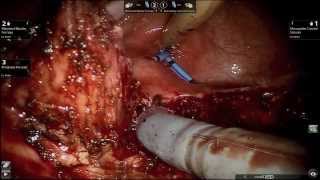 Vesicovaginal fistula dissection