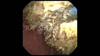 2.9 cm ( 1.5 x 1.5 x 1.3 ) kidney stone occupying left renal pelvis with HU of 1500. #treatment