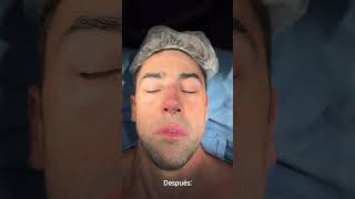 Rinoplastia ultrasónica con el Dr. Diego Rop 💣 MN136377 ✨