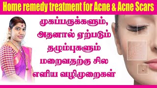 முகப்பரு & முகப்பரு தழும்புகள் மறைய எளிய வழிமுறைகள் | Home remedy treatment for Acne & Acne Scars