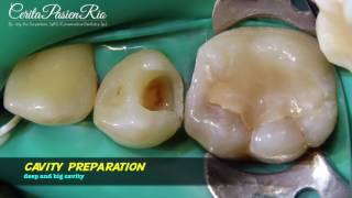 restoration of deep and big hidden cavity with composite resin (konservasi gigi jakarta)