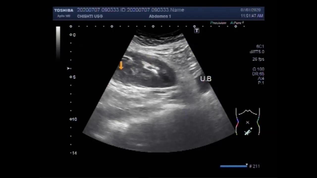 Ultrasound Video Showing An Ectopic Kidney With A Renal And Ureteral ...