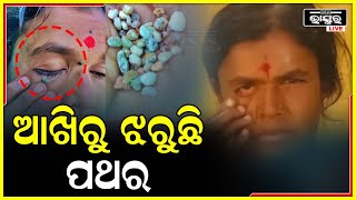 ଶିକ୍ଷୟତ୍ରୀଙ୍କ ଆଖିରୁ ଝରୁଛି  ୨୦୦ରୁ ଅଧିକ ପଥର, କଥାଟା ଅବିଶ୍ୱସନୀୟ ହେଲେ ବି ସତ, ଦେଖନ୍ତୁ ଏହି ଭିଡିଓ...