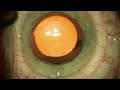 watch a real bladeless laser cataract surgery by dr cathleen mccabe