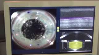 Watch a real Bladeless Laser Cataract Surgery by Dr Cathleen McCabe