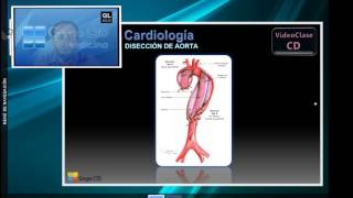 18  Disección de la aorta