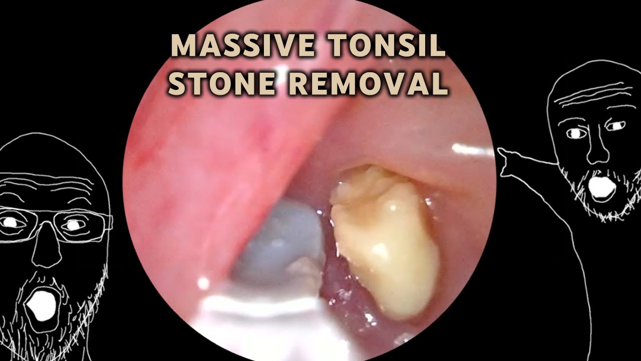 Multitude Of Massive Tonsil Stones Removed! | AIM 20 - YouTube