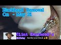 Blackhead removal on May 31st!!! #blackheadremoval #blackheads |@Dr.AMAZINGSKIN