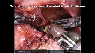 Asvide: Case presentations and repair of post-esophagectomy redundant conduit and para-conduit…