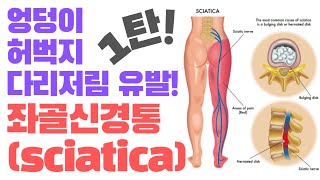 (엉덩이,허벅지통증,다리저림)좌골신경통 해결하는 첫번째 이야기!(How to Stop It NOW,Causes Sciatica)