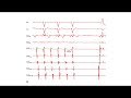 ecg u0026 ep tracings part 2